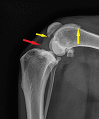 cruciate ligament repair edmonton - knee rupture xray